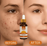 Before and after comparison of a face with acne treatment, featuring a bottle labeled 'Relax'.