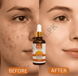 Before and after comparison of a face with acne treatment, featuring a bottle labeled 'Relax'.