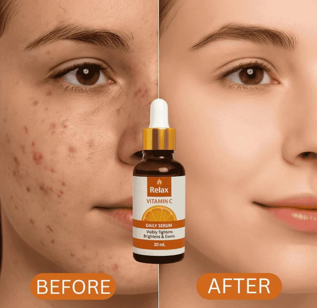 Before and after comparison of a face with acne treatment, featuring a bottle labeled 'Relax'.